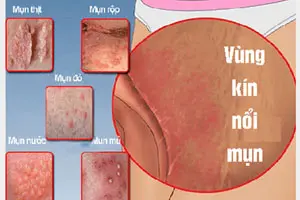 11 hình ảnh nổi mụn ở mép vùng kín nữ