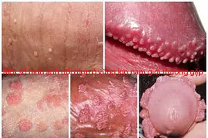 12 Hình ảnh nổi mụn ở vùng kín nam giới cảnh báo bệnh gì?