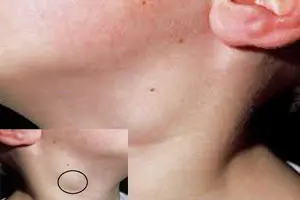 Nổi hạch ở cổ bên phải, trái, dưới cằm là bệnh gì? 