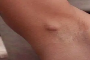 Nổi hạch ở nách trái nữ giới, nam giới có nguy hiểm không