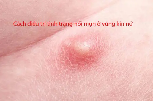 Cách điều trị tình trạng nổi mụn ở vùng kín nữ