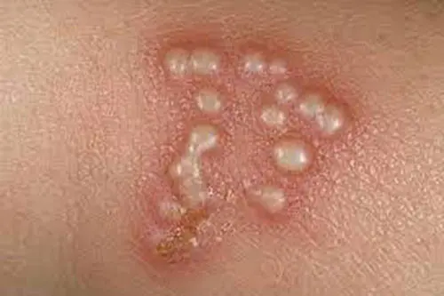 Hình ảnh mụn rộp sinh dục