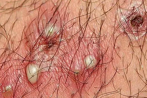 Hình ảnh lông mọc ngược