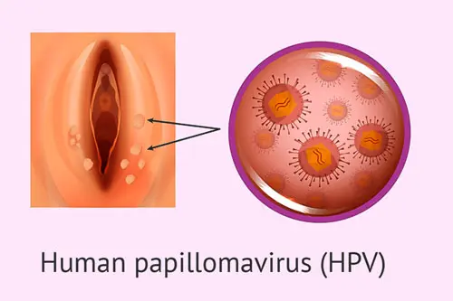 Hình ảnh nổi mụn ở mép vùng kín nữ