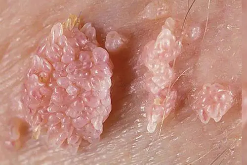 Hình ảnh nổi mụn rộp ở vùng kín nữ giới
