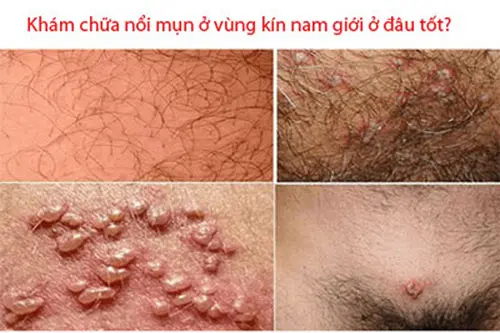 Khám nổi mụn ở vùng kín nam giới ở đâu tốt?