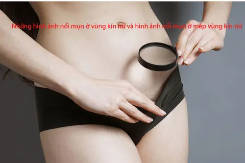 Những hình ảnh nổi mụn ở vùng kín nữ và hình ảnh nổi mụn ở mép vùng kín nữ