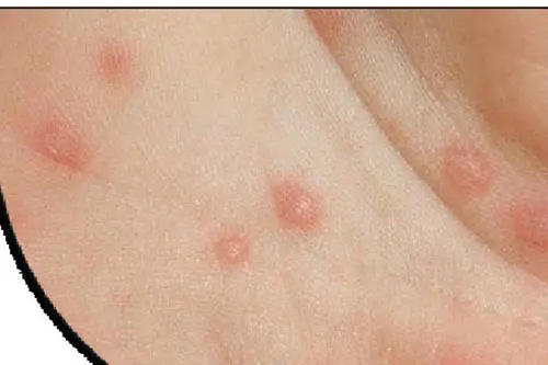 Nổi hạch ở cổ bên phải hoặc bên trái do bệnh giang mai: