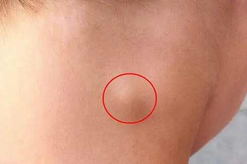Nổi hạch ở cổ có nguy hiểm không
