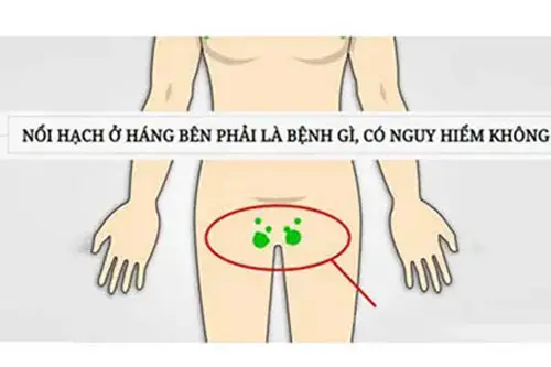 Nổi hạch ở háng có nguy hiểm không