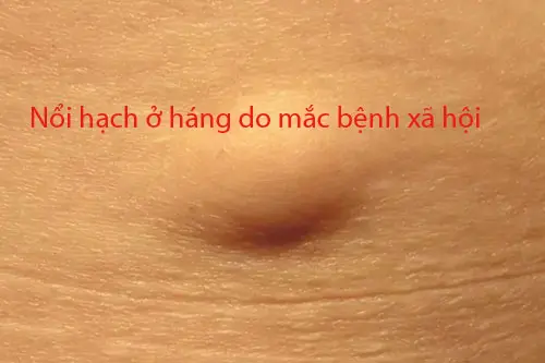 Nổi hạch ở háng do mắc bệnh xã hội