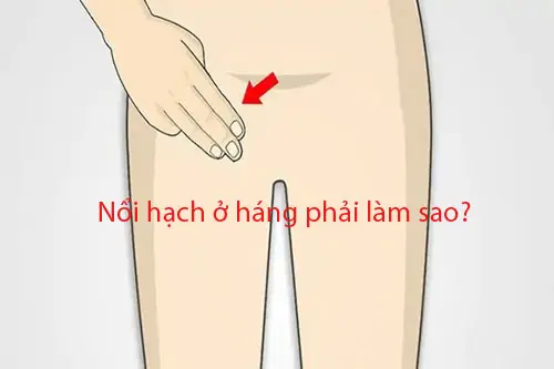 Nổi hạch ở háng phải làm sao?
