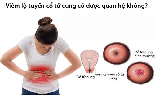 Viêm lộ tuyến cổ tử cung có được quan hệ không